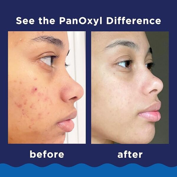 PanOxyl Acne Foaming Wash Benzoyl Peroxide 10% Maximum Strength Antimicrobial, 5.5 Oz - Image 2